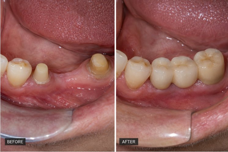 Photo representative of a dental bridge