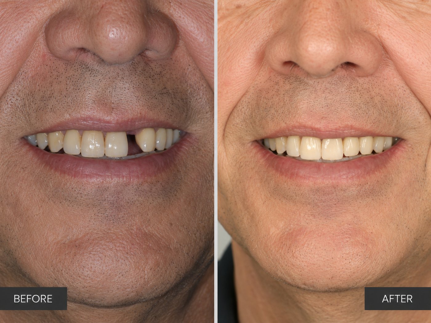 Restore Your Smile with A Dental Implant