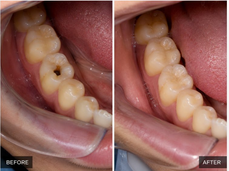 Natural-Looking Restoration