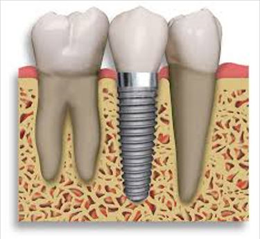 A Natural-Looking Tooth Replacement