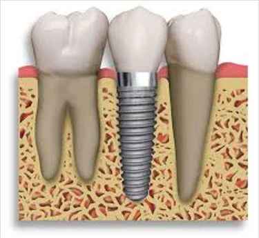 A Natural-Looking Tooth Replacement