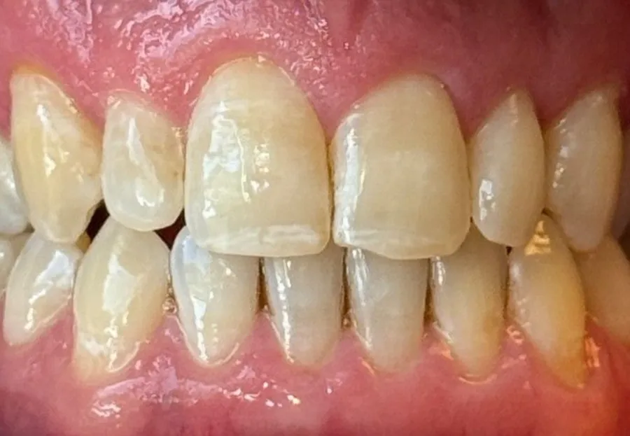 After Invisalign crossbite correction at Futch Dental in Reno, NV