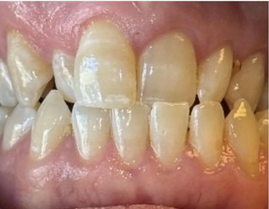 Before Invisalign crossbite correction at Futch Dental in Reno, NV