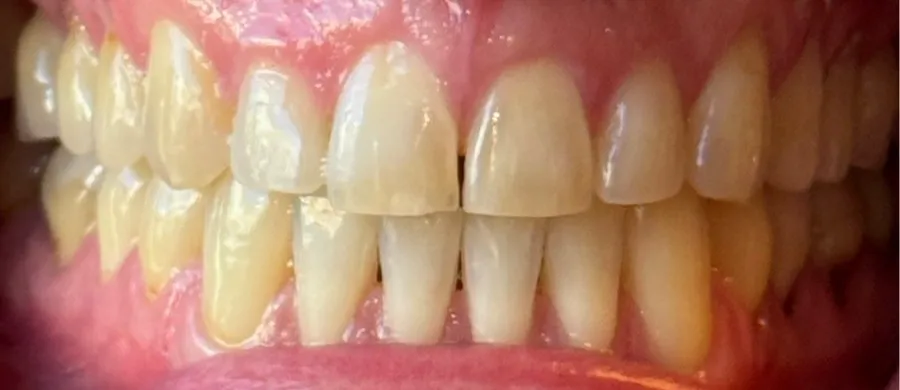 After Invisalign gap closure treatment at Futch Dental in Reno, NV