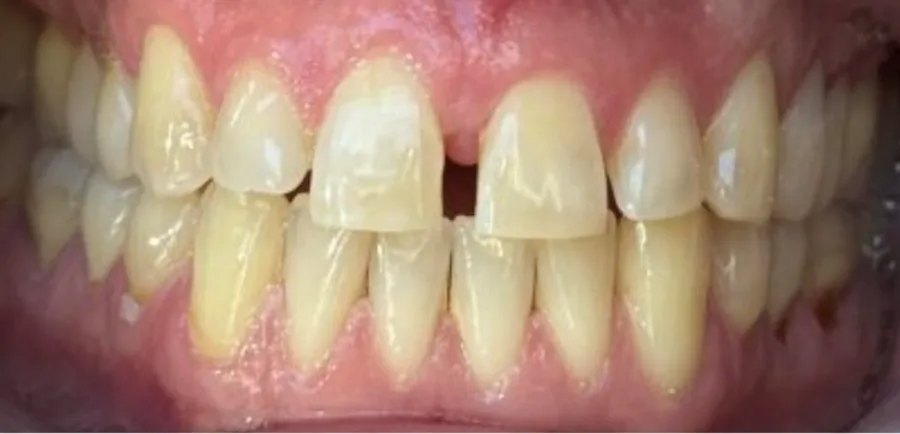 Before Invisalign gap closure treatment at Futch Dental in Reno, NV