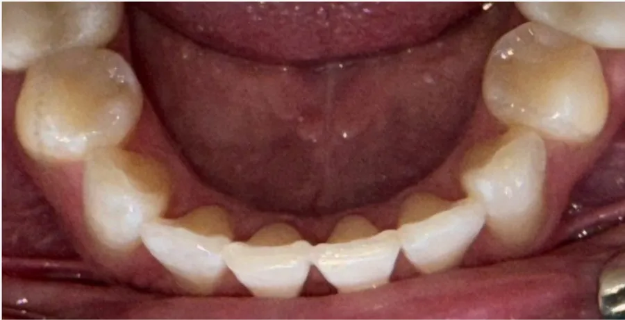 After Invisalign treatment for minor lower crowding at Futch Dental in Reno, NV