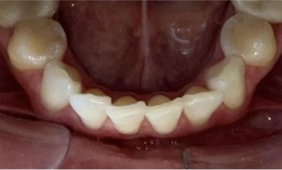 Before Invisalign treatment for minor lower crowding at Futch Dental in Reno, NV