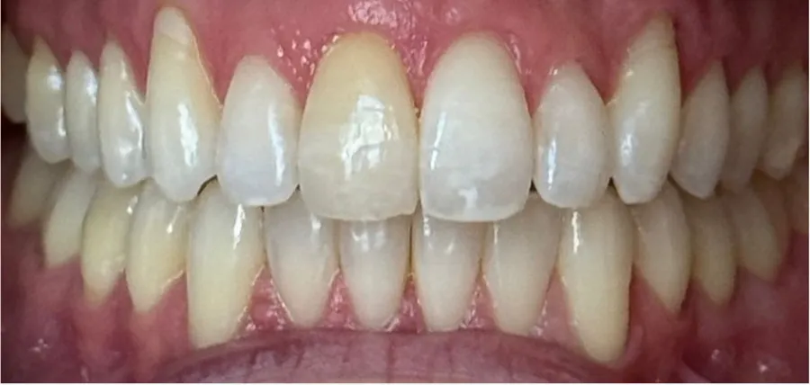 After Invisalign treatment for upper crowding at Futch Dental in Reno, NV