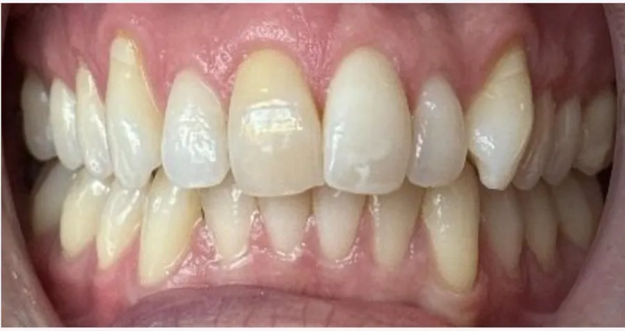 Before Invisalign treatment for upper crowding at Futch Dental in Reno, NV