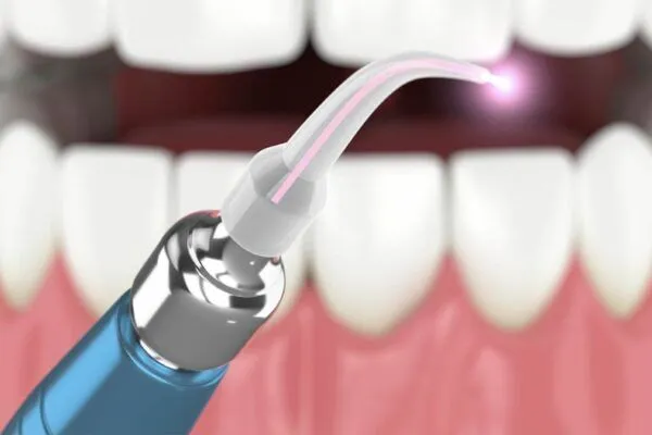 Soft-tissue laser dentistry